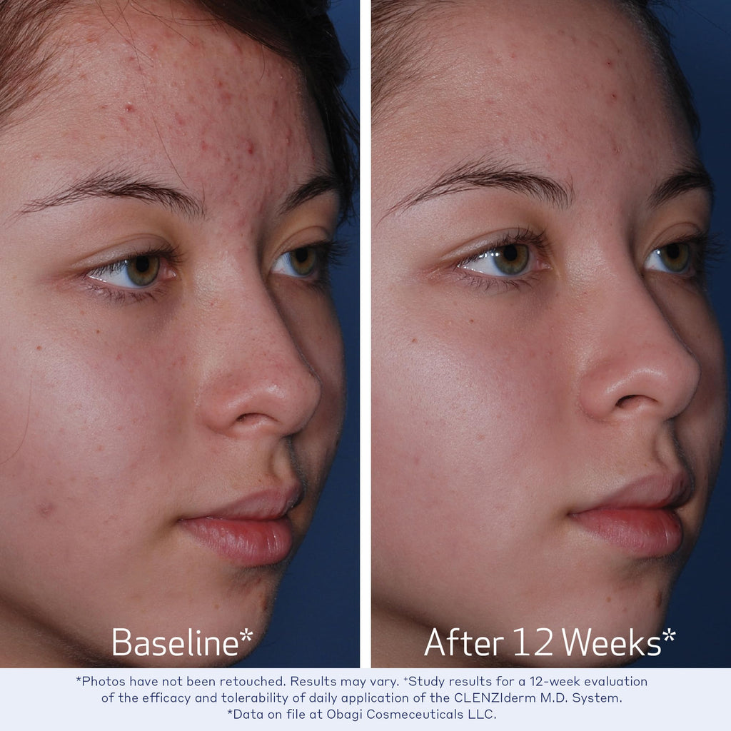 Obagi CLENZIderm M.D. Daily Care Foaming Acne Cleanser – 2% Salicylic Acid (BHA) for Clearer-Looking Skin